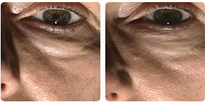 EYELISSTM (АЙЛИСTM) – КОМБИНАЦИЯ ИЗ ТРЕХ ИННОВАЦИОННЫХ МОЛЕКУЛ: лицо ДО и ПОСЛЕ