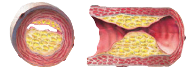 ANGINĂ PECTORALĂ ISCHEMIE ATAC CEREBRAL INFARCT